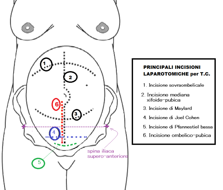 Taglio Cesareo Tecnica Chirurgica Fertilitycenter