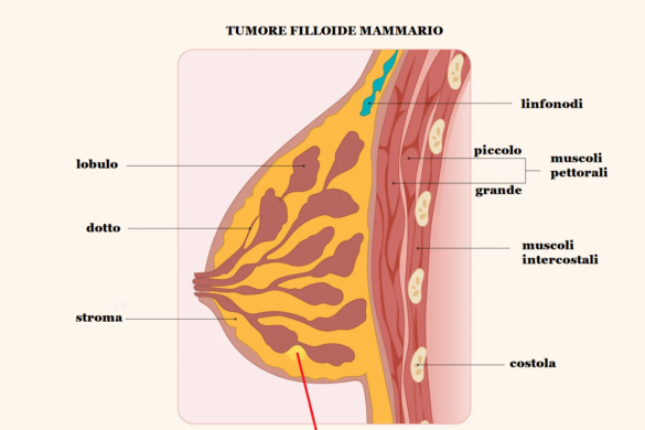 Lesioni Pre Neoplastiche Della Cervice Uterina CIN SIL ASC US