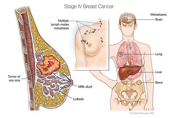 Ooforectomia: protezione da tumore mammario differisce con